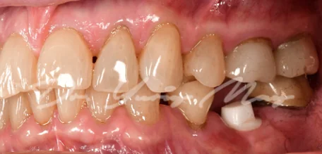 Posterior zirconia implant case 03 at placement