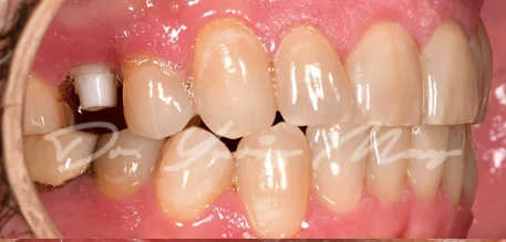 Posterior zirconia implant case 04 at placement