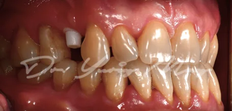 Posterior zirconia implant case 05 at placement