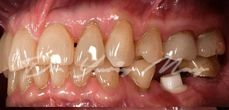 Posterior zirconia implant case 06 at placement