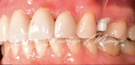 Posterior zirconia implant case 07 at placement