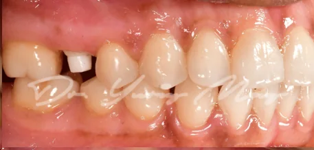 Posterior zirconia implant case 08 at placement