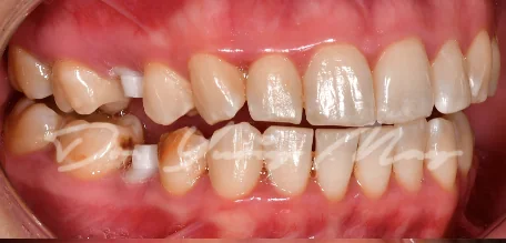 Posterior zirconia implant case 09 at placement