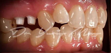 Posterior zirconia implant case 10 at placement