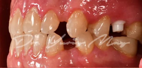 Posterior zirconia implant case 11 at placement