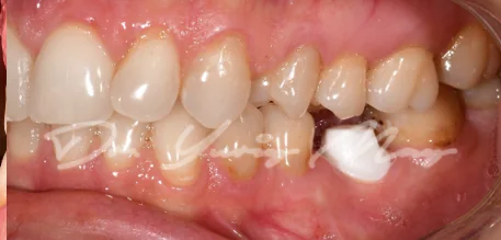 Posterior zirconia implant case 12 at placement