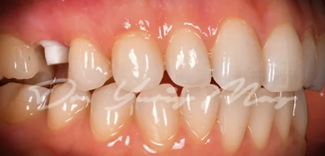 Posterior zirconia implant case 13 at placement
