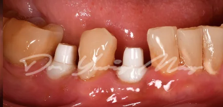 Posterior zirconia implant case 14 at placement