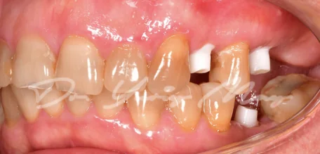 Posterior zirconia implant case 15 at placement