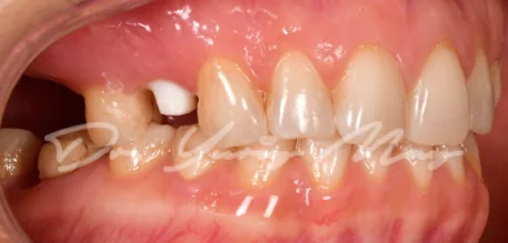 Posterior zirconia implant case 16 at placement